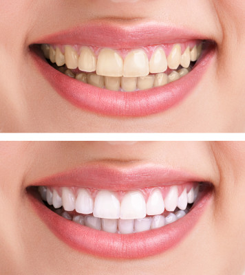 Dentisterie esthetique et fonctionlle Dentisterie esthétique Boucherville