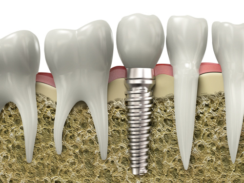 courone sur implant